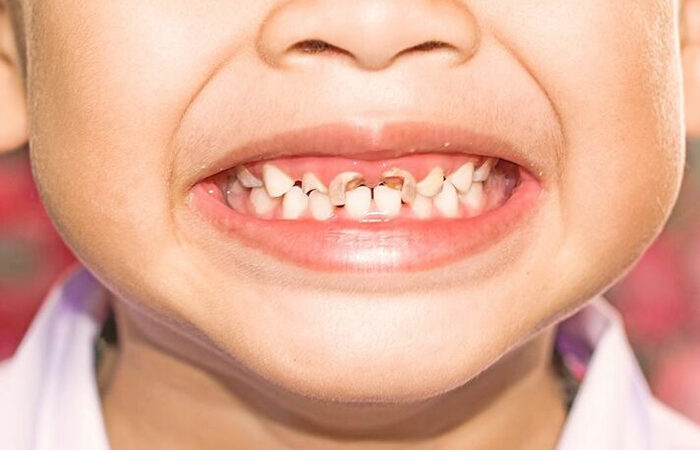Vì sao trẻ em dễ bị sâu răng?