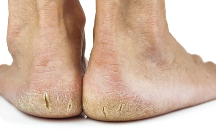 Vì sao da gót chân dễ bị nứt nẻ? Cách bảo vệ da chân luôn khỏe mạnh